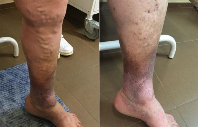 Venski ulkus: Kako do dijagnoze i izlečenja?